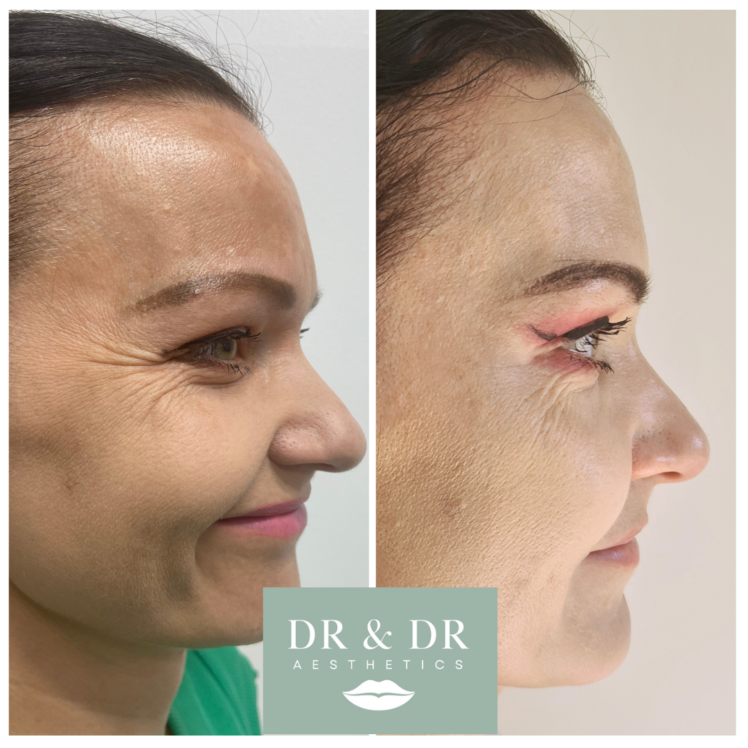 Before and after images of a woman's profile showing improved skin texture and appearance after aesthetic treatment, with the logo 'DR & DR AESTHETICS' at the bottom.