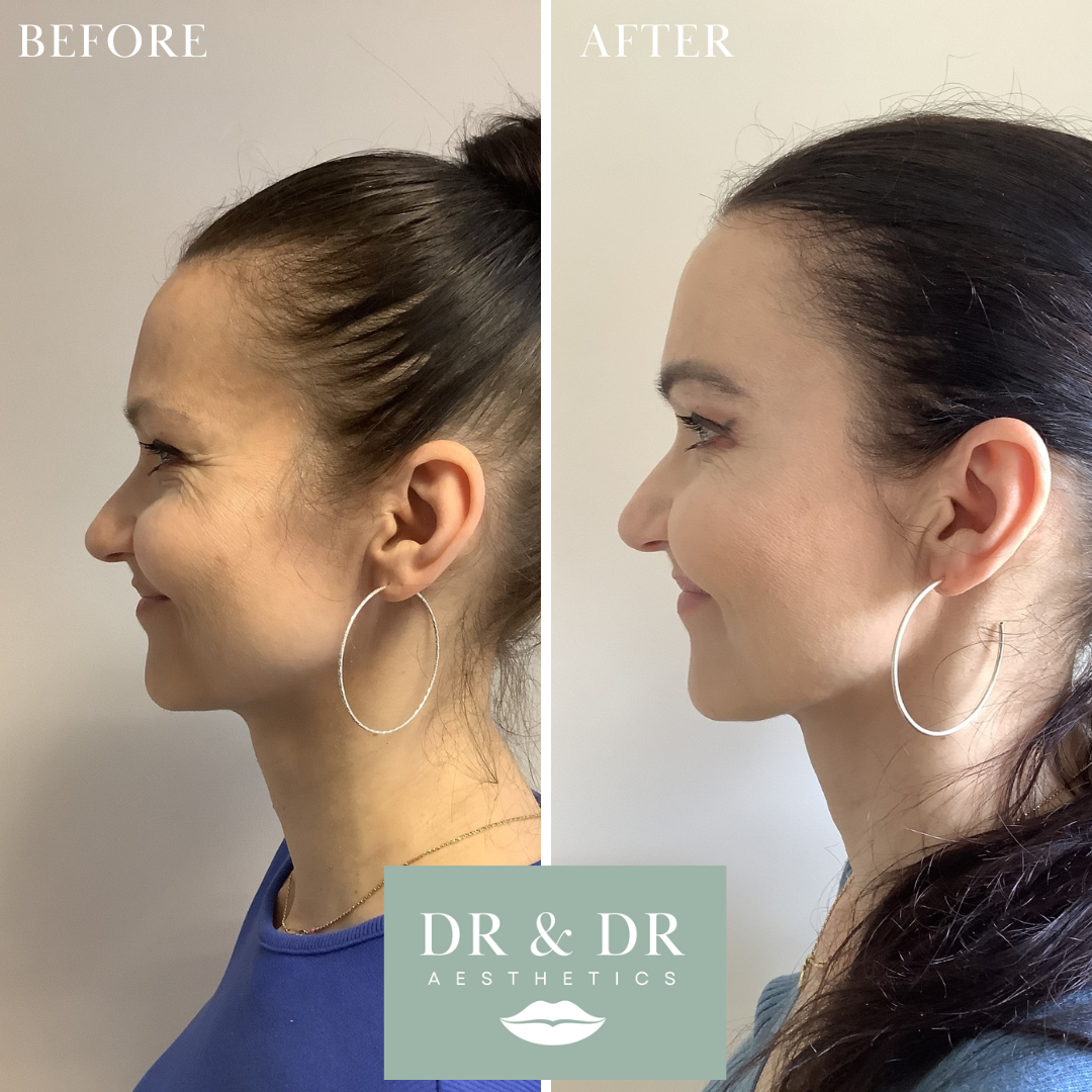 Side-by-side comparison of a woman before and after aesthetic treatment, showing improved jawline and skin texture, with the woman wearing large hoop earrings in both images.