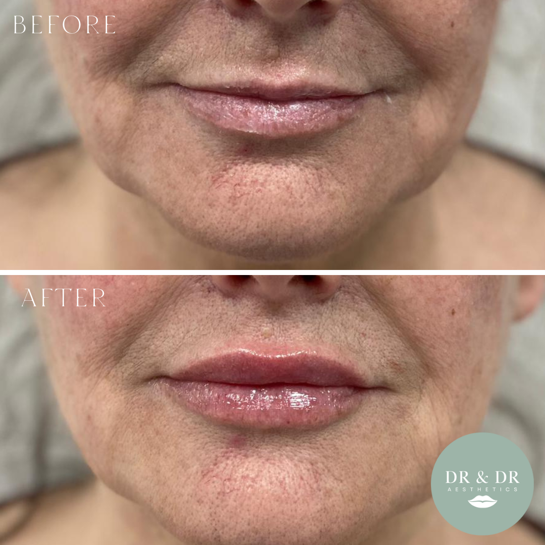 Close-up of a person's lips before and after cosmetic enhancement, showing fuller, glossier lips in the after photo.