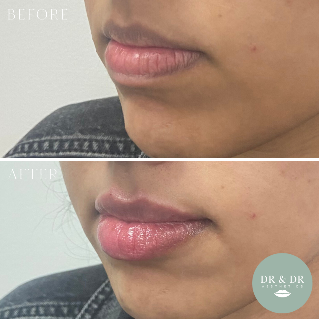 Close-up of a person's lips before and after lip enhancement procedure, showing fuller, moisturized lips in the after image with a logo for DR & DR Aesthetics.