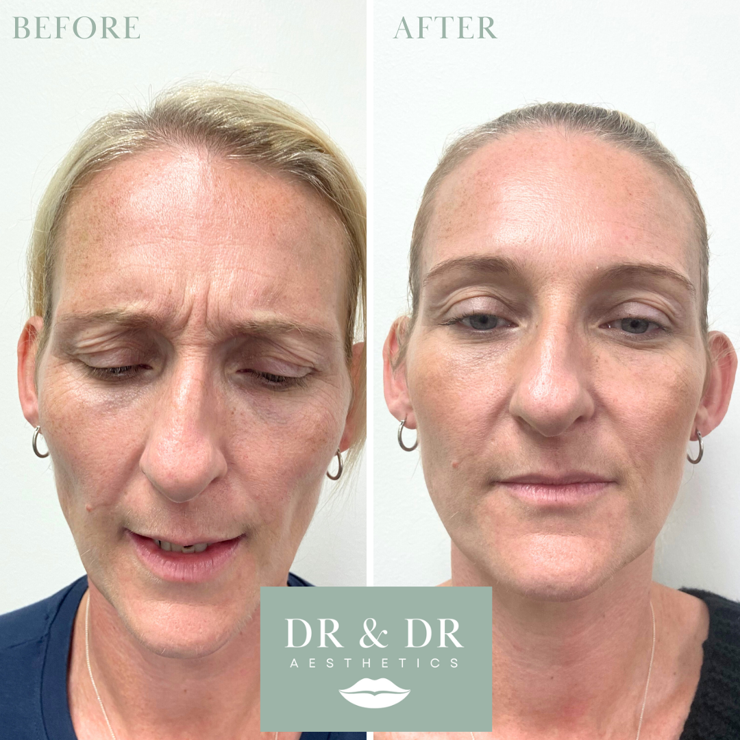 Side-by-side comparison of a woman's face before and after aesthetic treatment, showing smoother skin and reduced wrinkles.