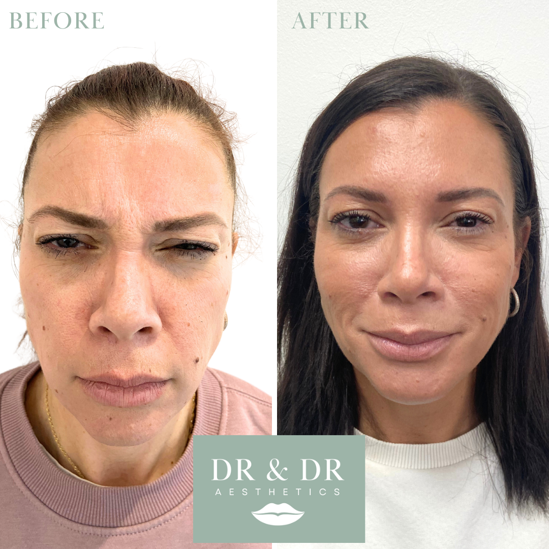 Comparison photo showing a woman's face before and after cosmetic treatment. The 'before' side shows a woman with uneven skin texture, fine lines, and dull complexion. The 'after' side shows the same woman with smoother skin, fewer lines, and a more 
