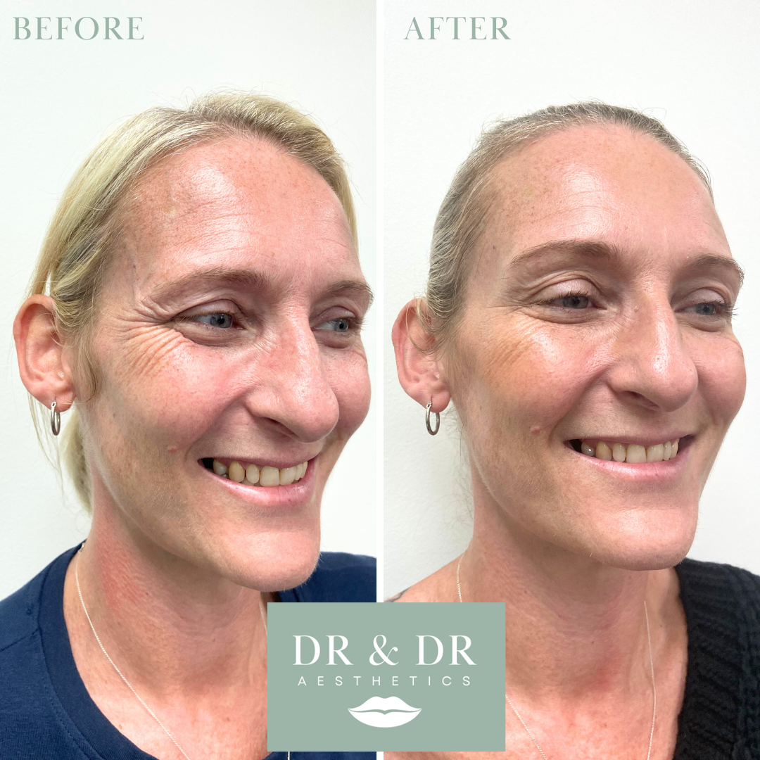 Before and after images of a woman showing facial improvements, with the logo 'DR & DR Aesthetics' at the bottom center.