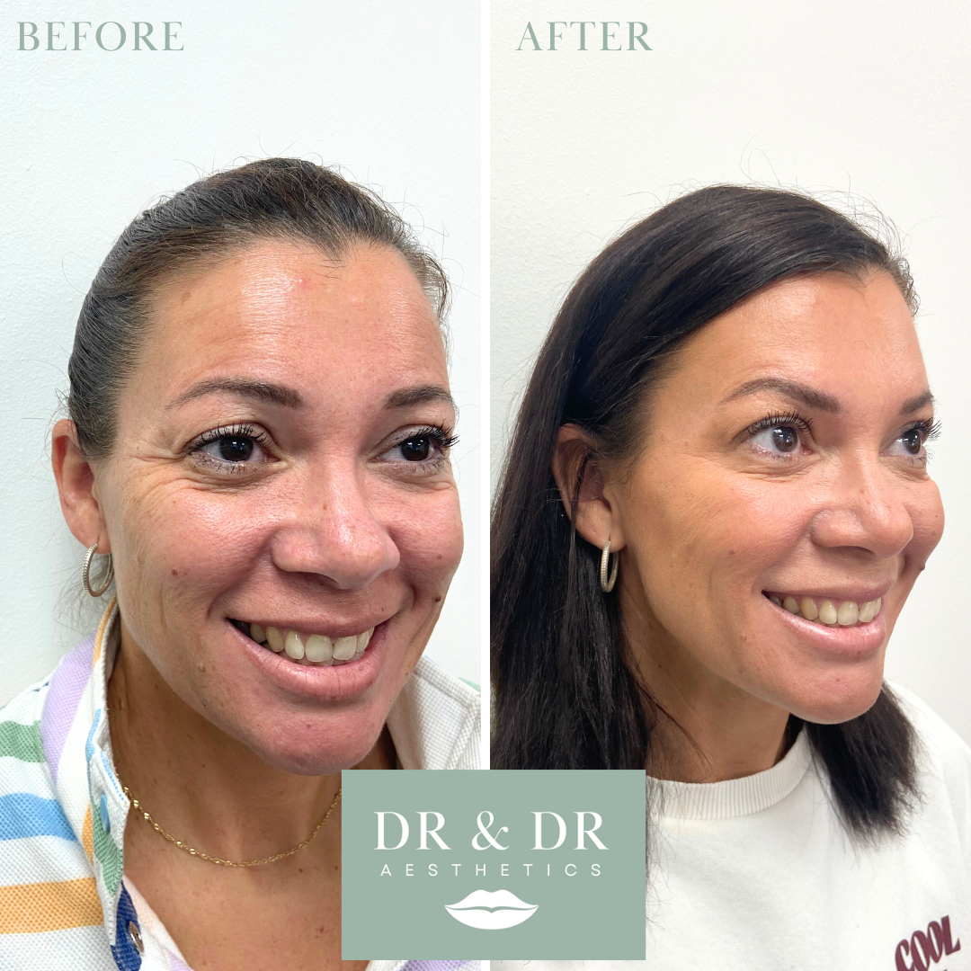 Side-by-side comparison of a woman's face before and after cosmetic treatment, showing improved skin texture and tone, with the words 'BEFORE' and 'AFTER' at the top and the logo 'DR & DR Aesthetics' at the bottom.