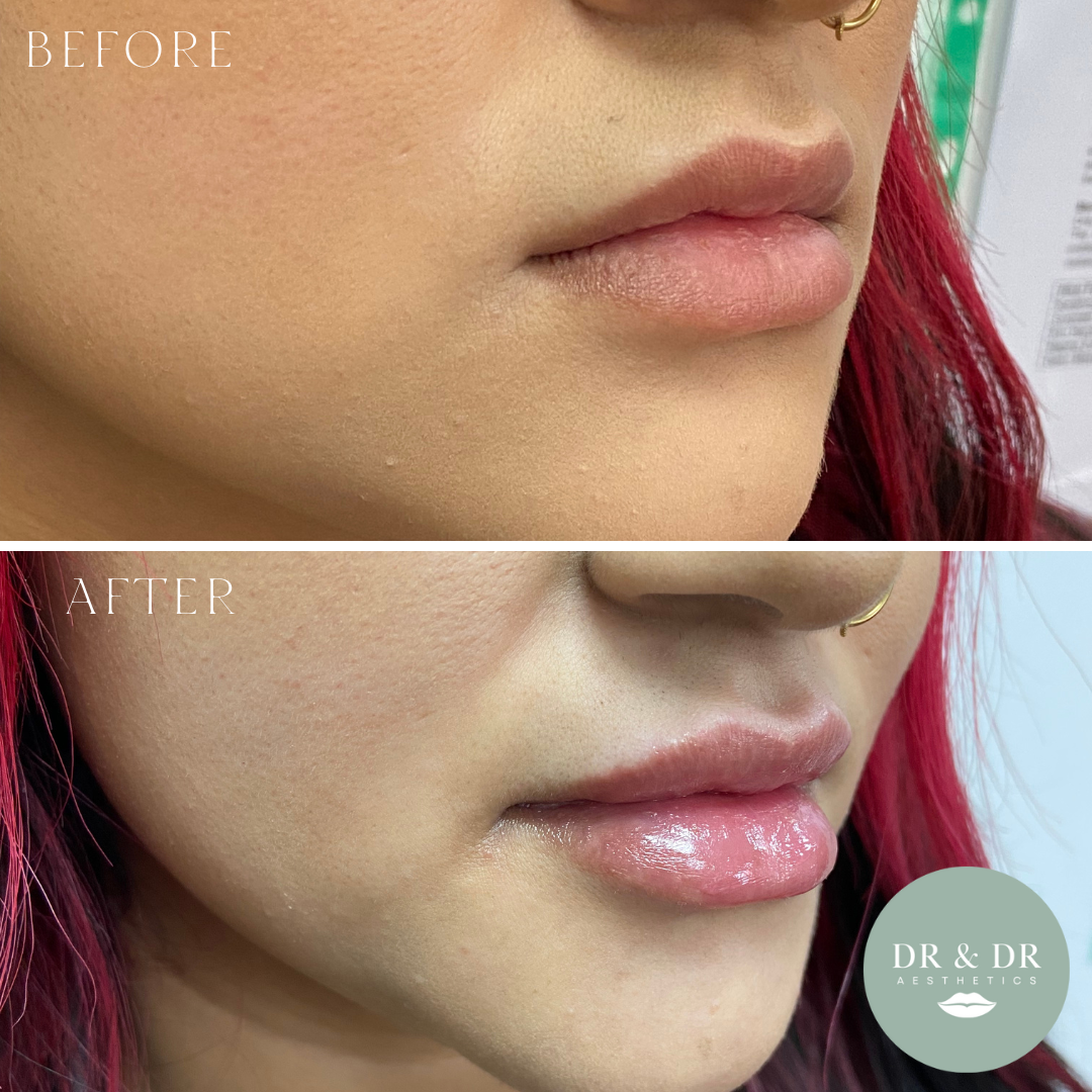 Close-up of a woman's lips and lower face showing before and after lip enhancement, with the after image displaying fuller, glossy lips. The woman has red hair and a small gold nose ring.