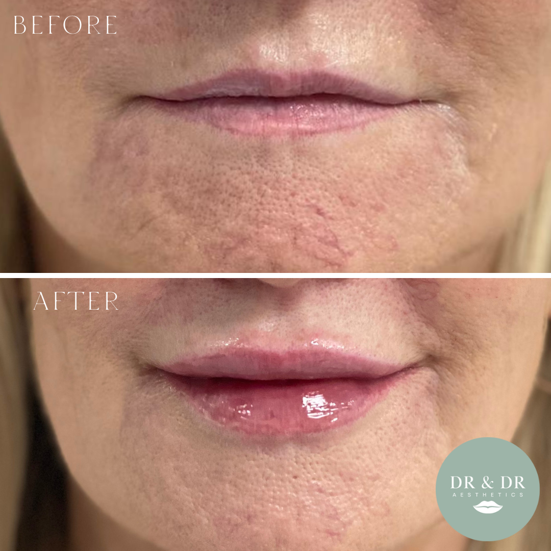 Close-up of a person's lips and surrounding skin showing a before-and-after comparison of skin appearance, with the after image showing smoother, more hydrated lips and skin.