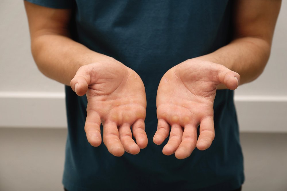 man with sore hands