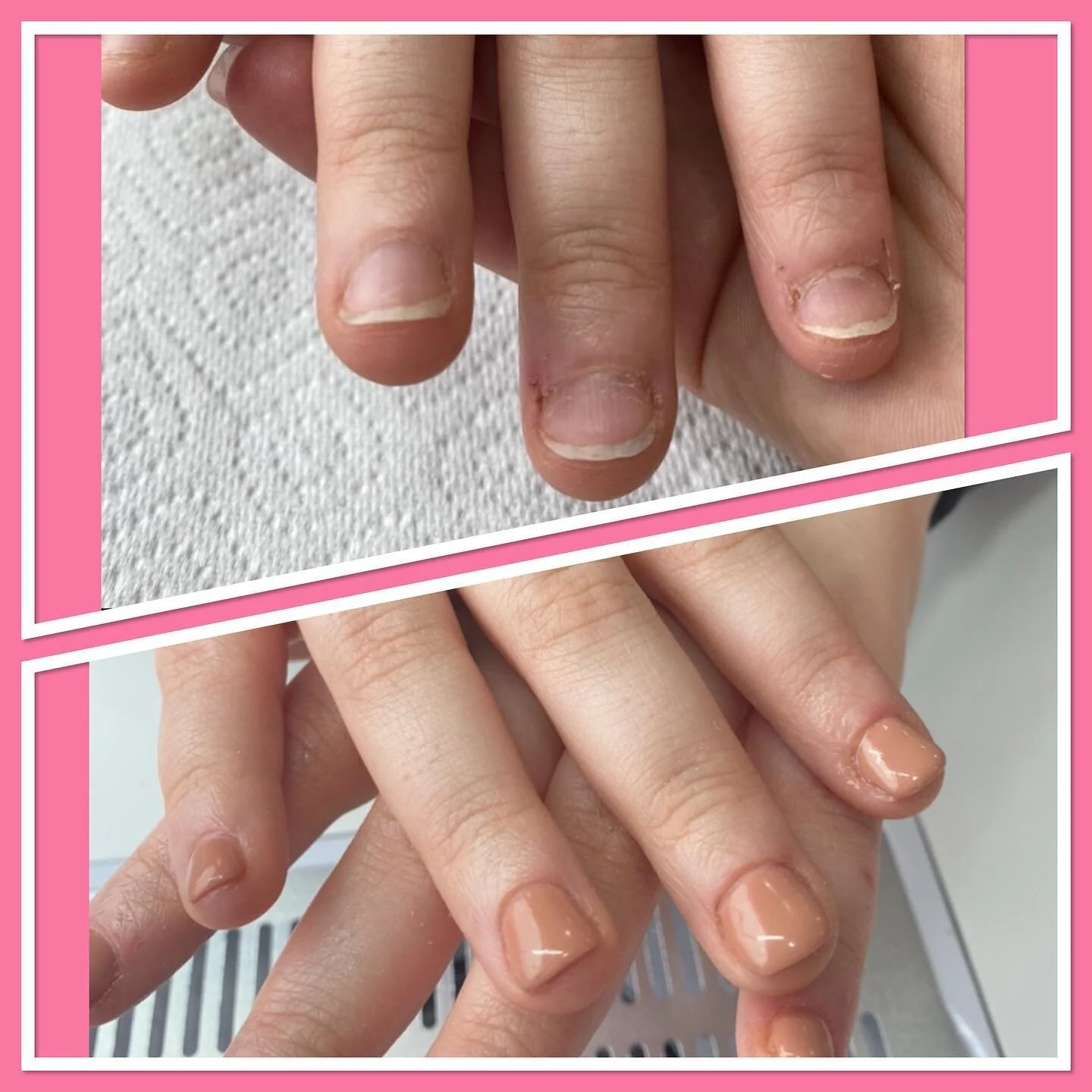 NAIL REHAB 👌🏽🤩

My client first came to me with bitten nails and wanted to grow her nails as it was getting her down . So I suggested BIAB . 

The before and after picture is just a 3 weeks difference ! 😮 

I can&rsquo;t wait to see her in anothe