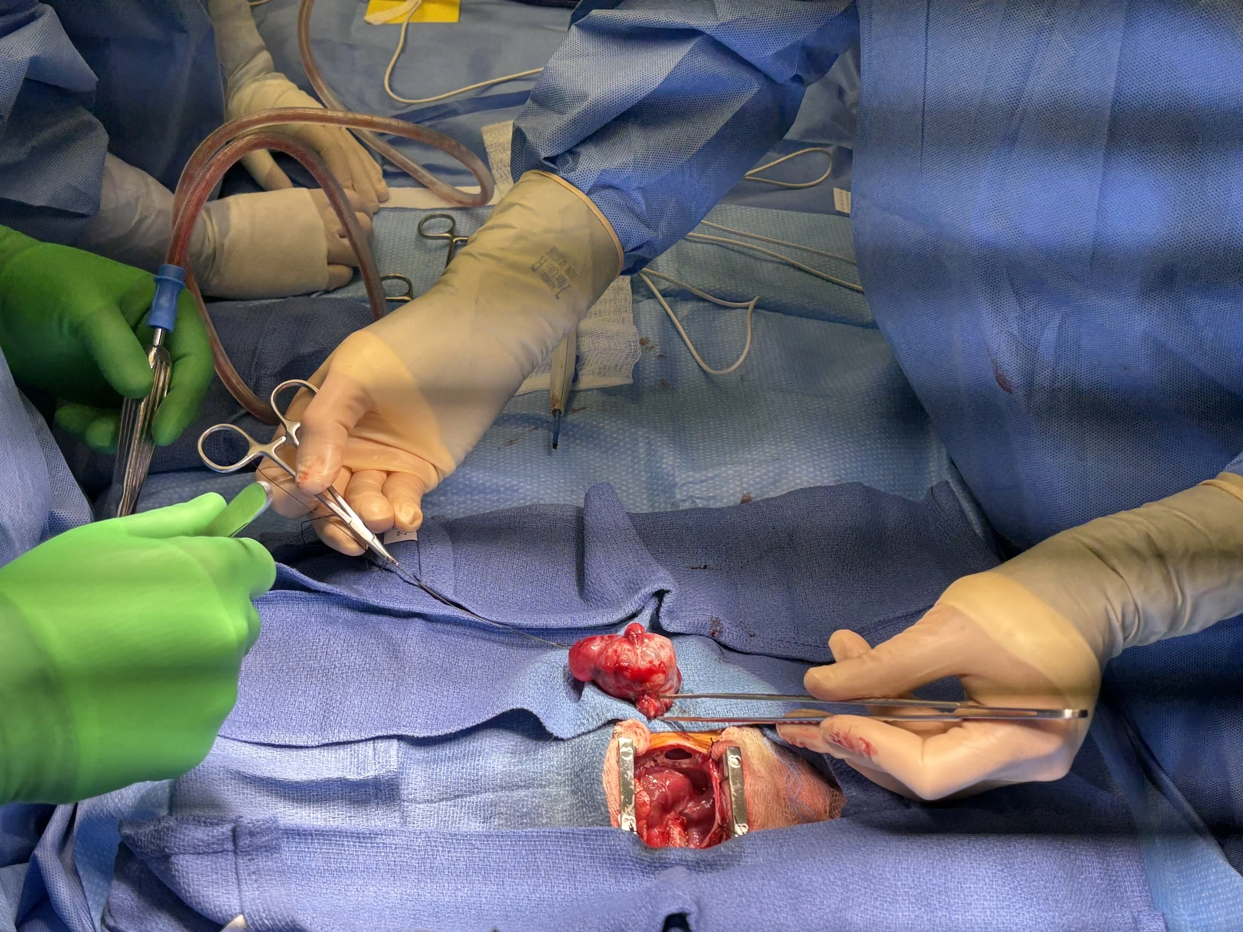 Epicardial Teratoma in Neonate