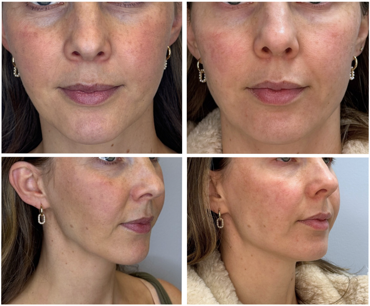 Restoring Youthful Contours