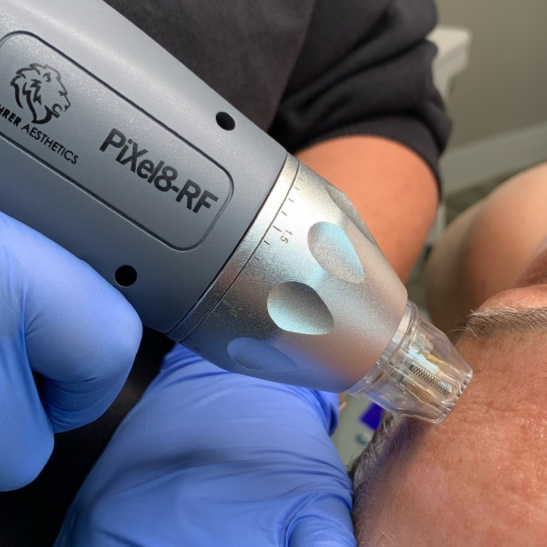 Radio Frequency Microneedling