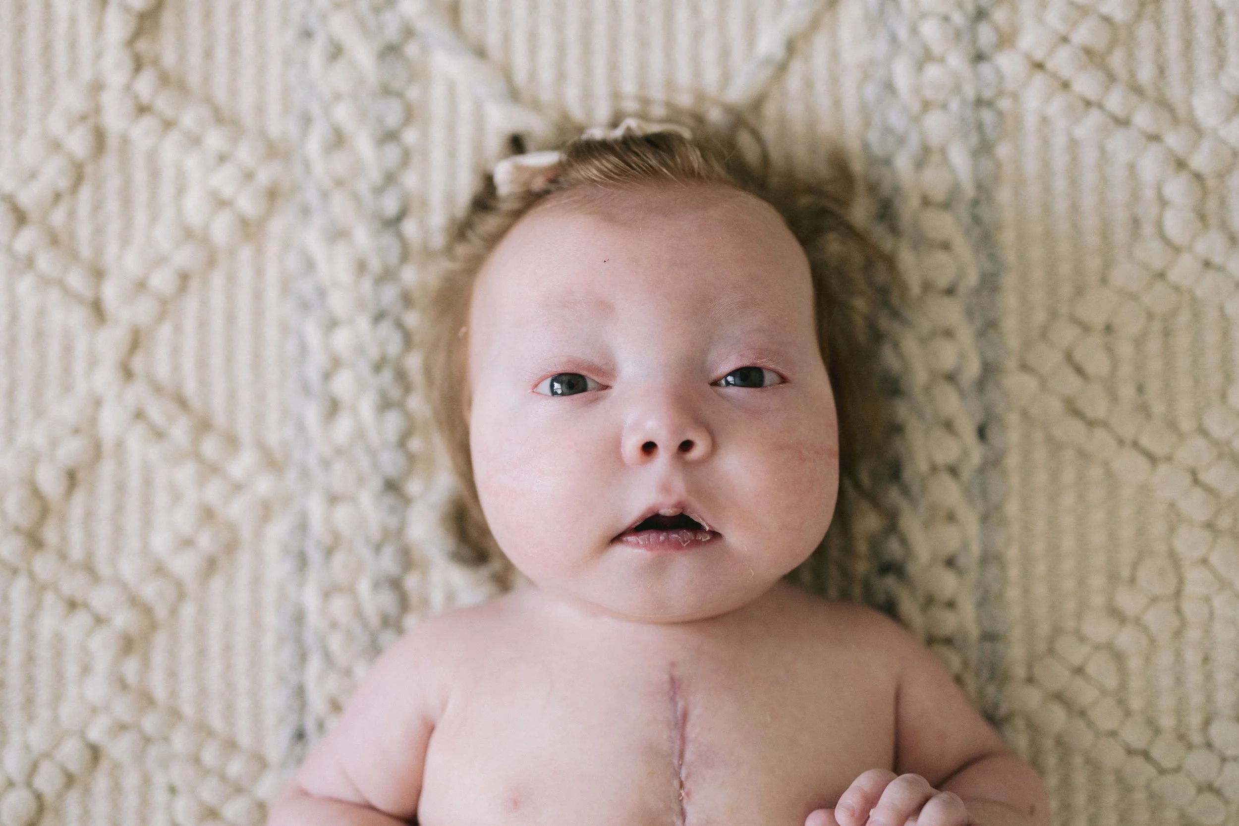 Close-up of a newborn baby lying on a textured cream-colored blanket, with a visible surgical scar on the chest.