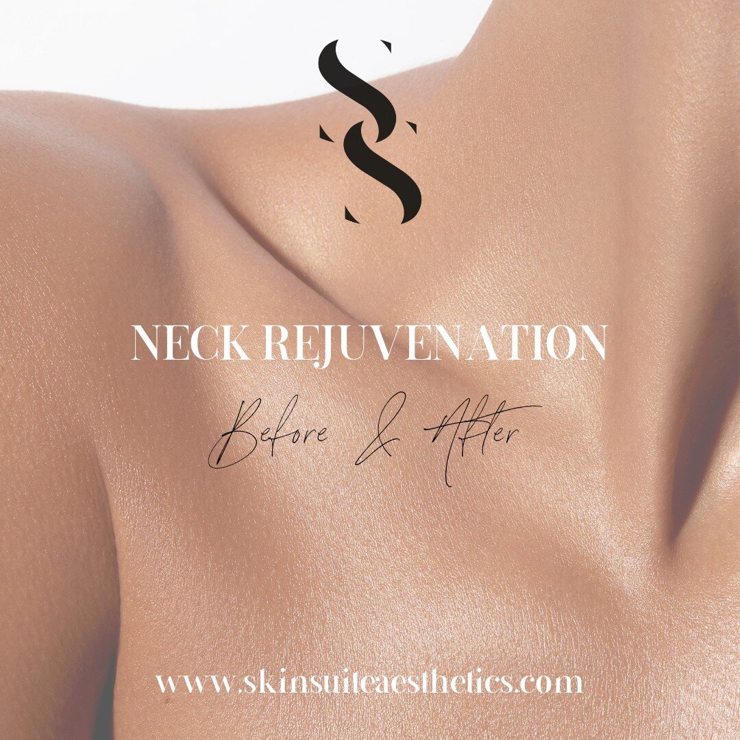 NECK REJUVENATION with Beckie ​​​​​​​​​
Swipe to see the before &amp; after 😍

Using anti-wrinkle injections to reduce the appearance of neck &amp; skin wrinkles - results are just amazing!

Cosmetic injectables may be used to rejuvenate the neck - 