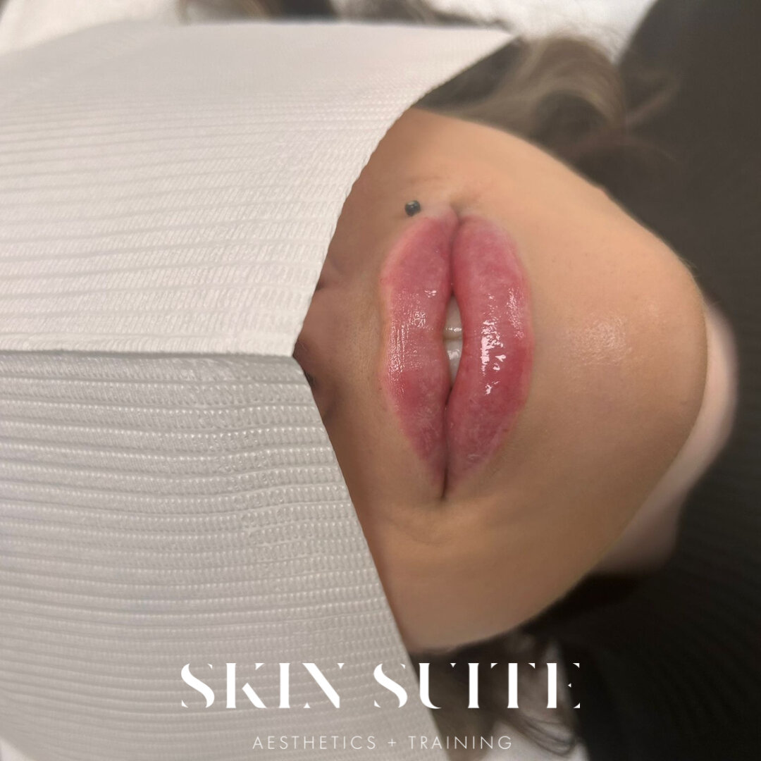 Lips by Beckie 💋​​​​​​​​​
Say hello to our lip enhancing - using our favourite dermal filler @kairax_uk used to add volume and instant definition...

Swipe to see the before &amp; after results - a natural enhancement we LOVE every time at SS!

We a