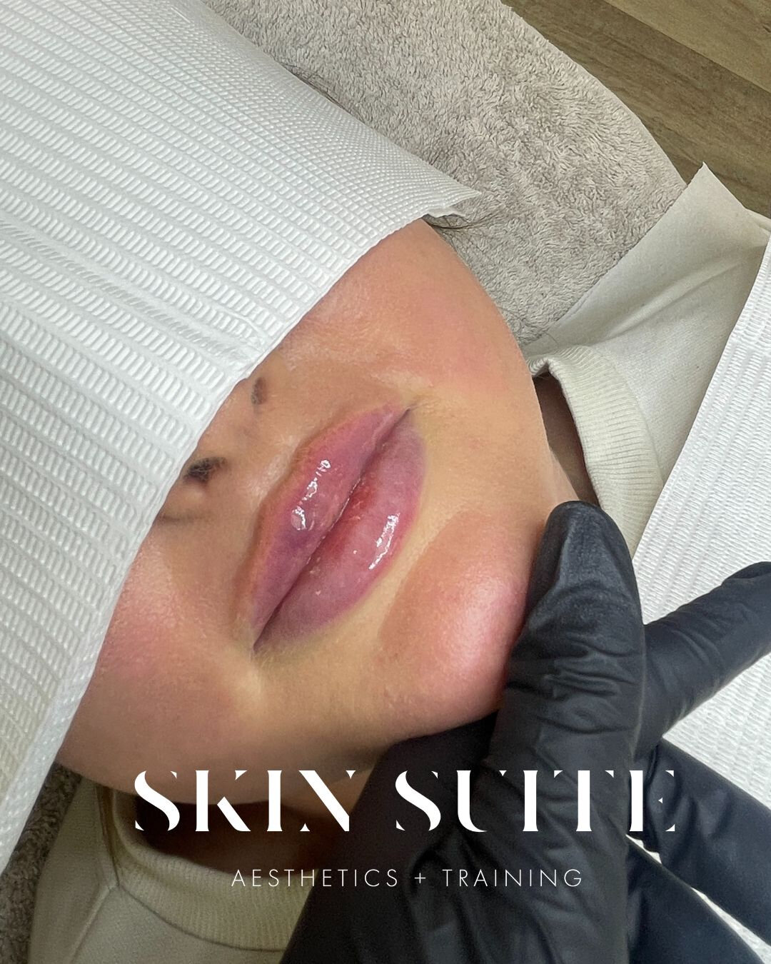 Did someone say lips? 👄​​​​​​​​​

Lip enhancement by Jodi using premium filler @kairax_uk designed to add back lip definition &amp; balance in volume!

Advanced aesthetics practitioner 
Qualified &amp; Insured 
Emergency / Complications Trained 
Adv