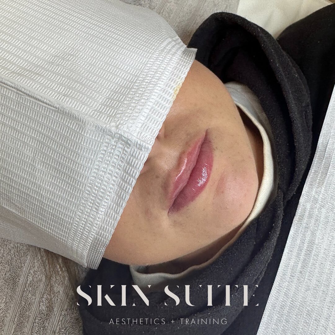 A beautiful &amp; natural enhancement. 😍

After dissolving previous filler which had built up over the years, we started again and created natural and soft lips&hellip;

Using KAIRAX for a premium filler used for instant &amp; safe results! 

Start 