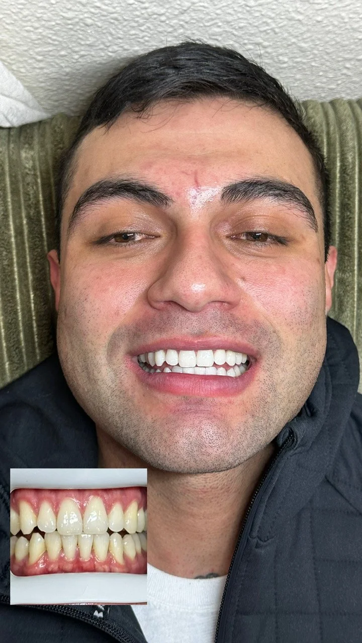 Before and after teeth whitening results