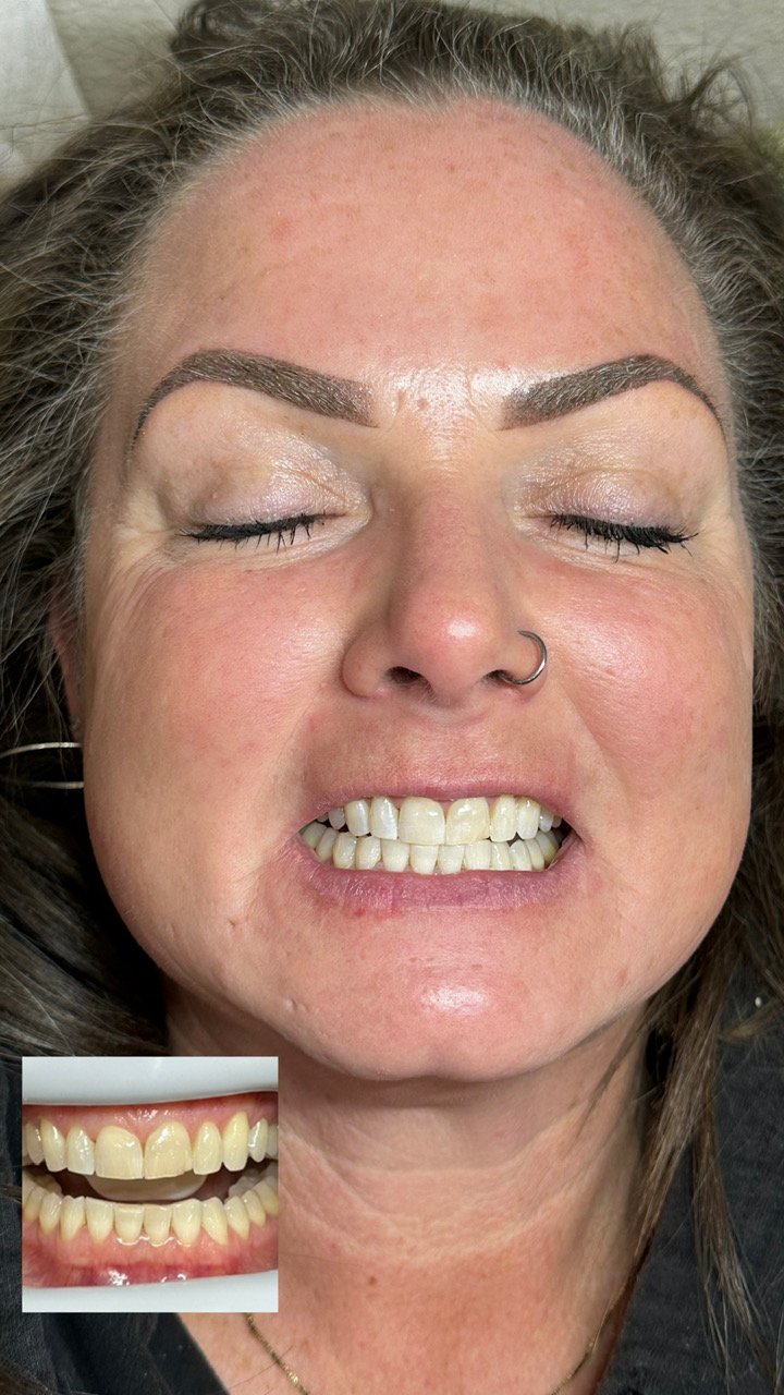 Before and after teeth whitening results