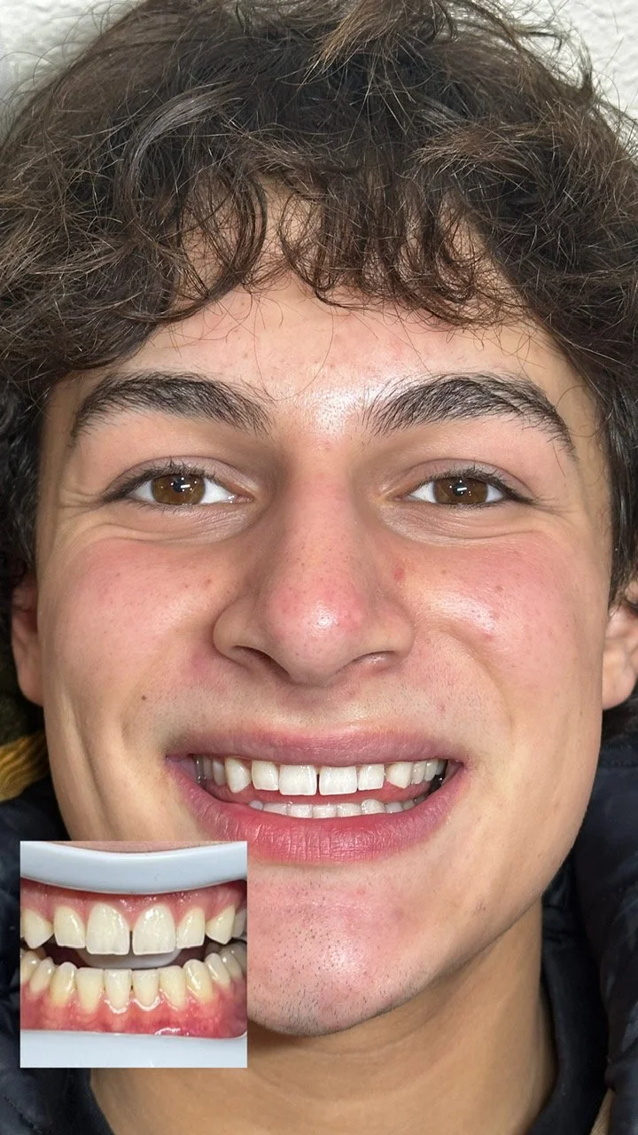 teeth-whitening-santa-rosa