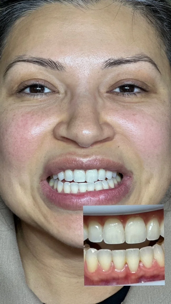 teeth-whitening-santa-rosa