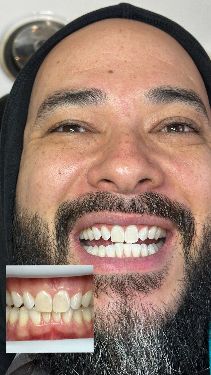 Before and after teeth whitening results