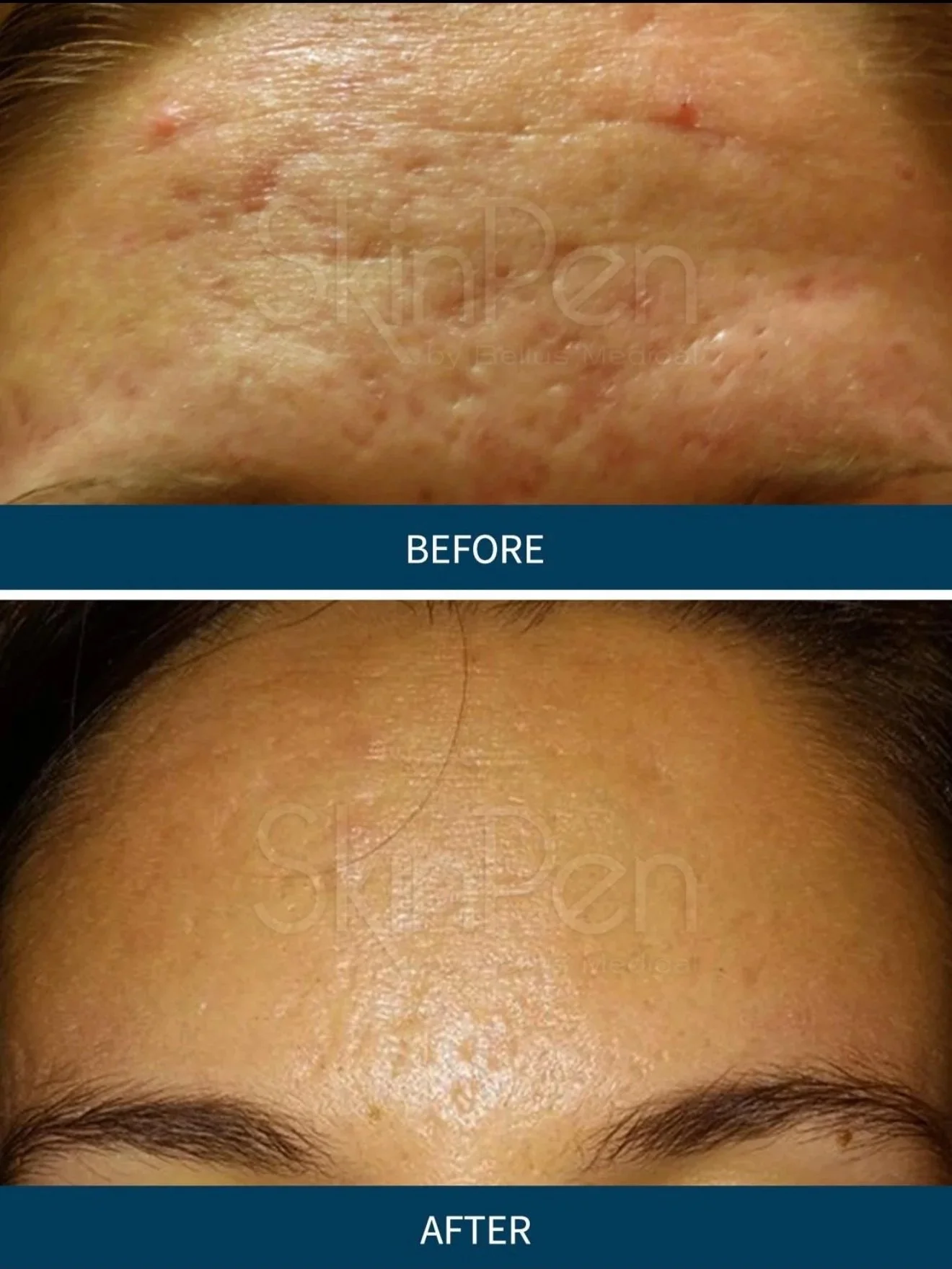 Before and after images of a person's face showing improvement in acne and skin clarity
