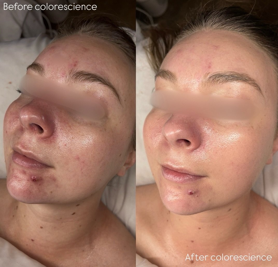 Redness? We don&rsquo;t know her. 

On the left: a bit of redness and uneven tone

On the right: even skin tone, reduced redness, and that healthy, radiant glow. 😍

✨ Colorescience isn&rsquo;t just sunscreen&mdash;it&rsquo;s a daily skincare treatme