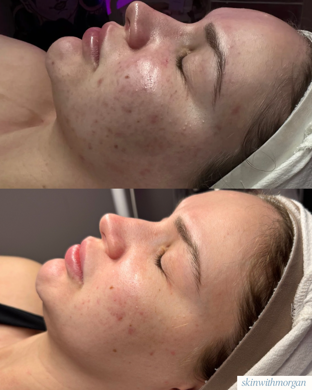 Before and after images of a person's face showing improvement in acne and skin clarity