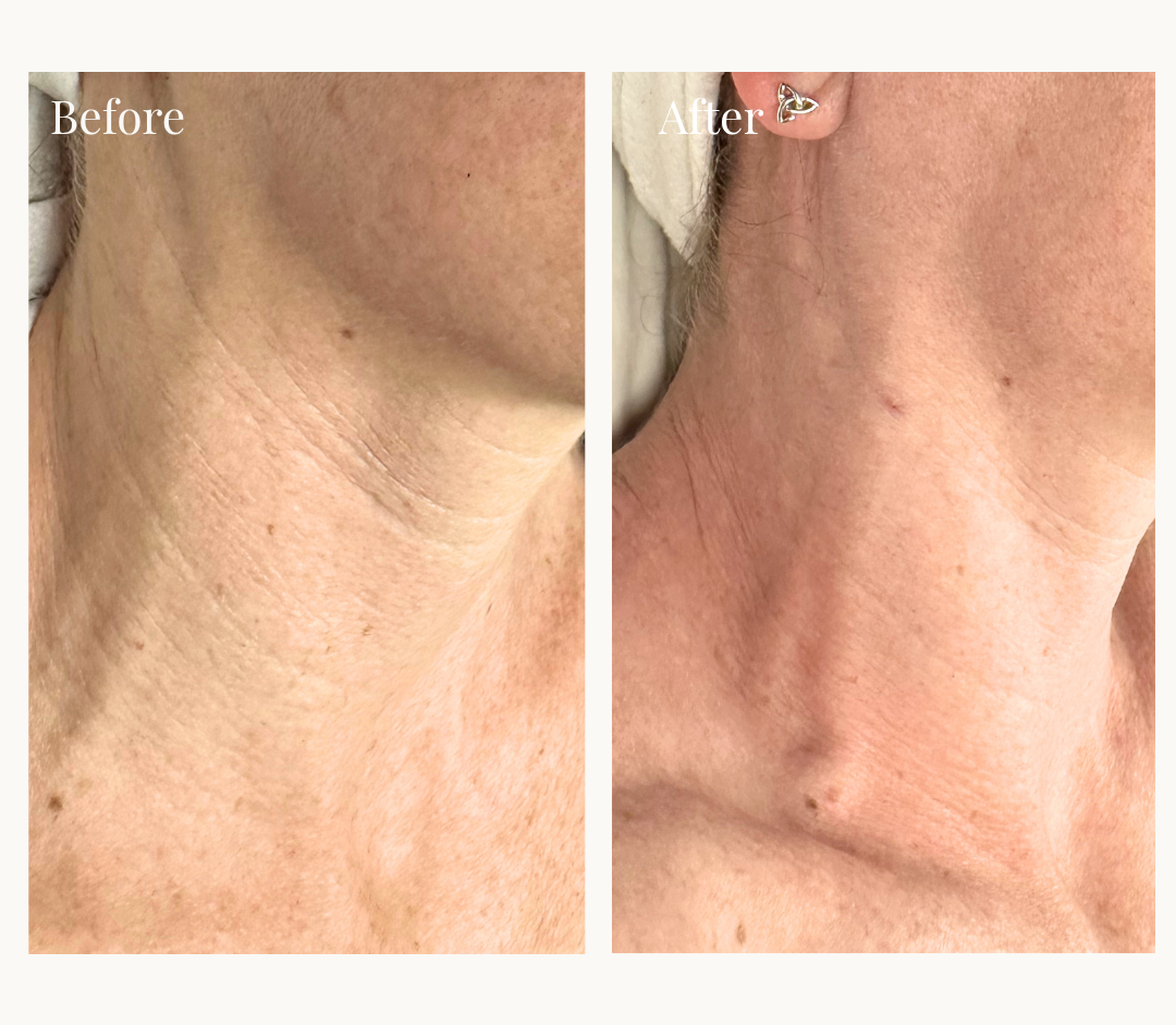 Side-by-side comparison of a man's lower face before and after laser skin treatment, showing improvement in skin texture and reduction of scars. 