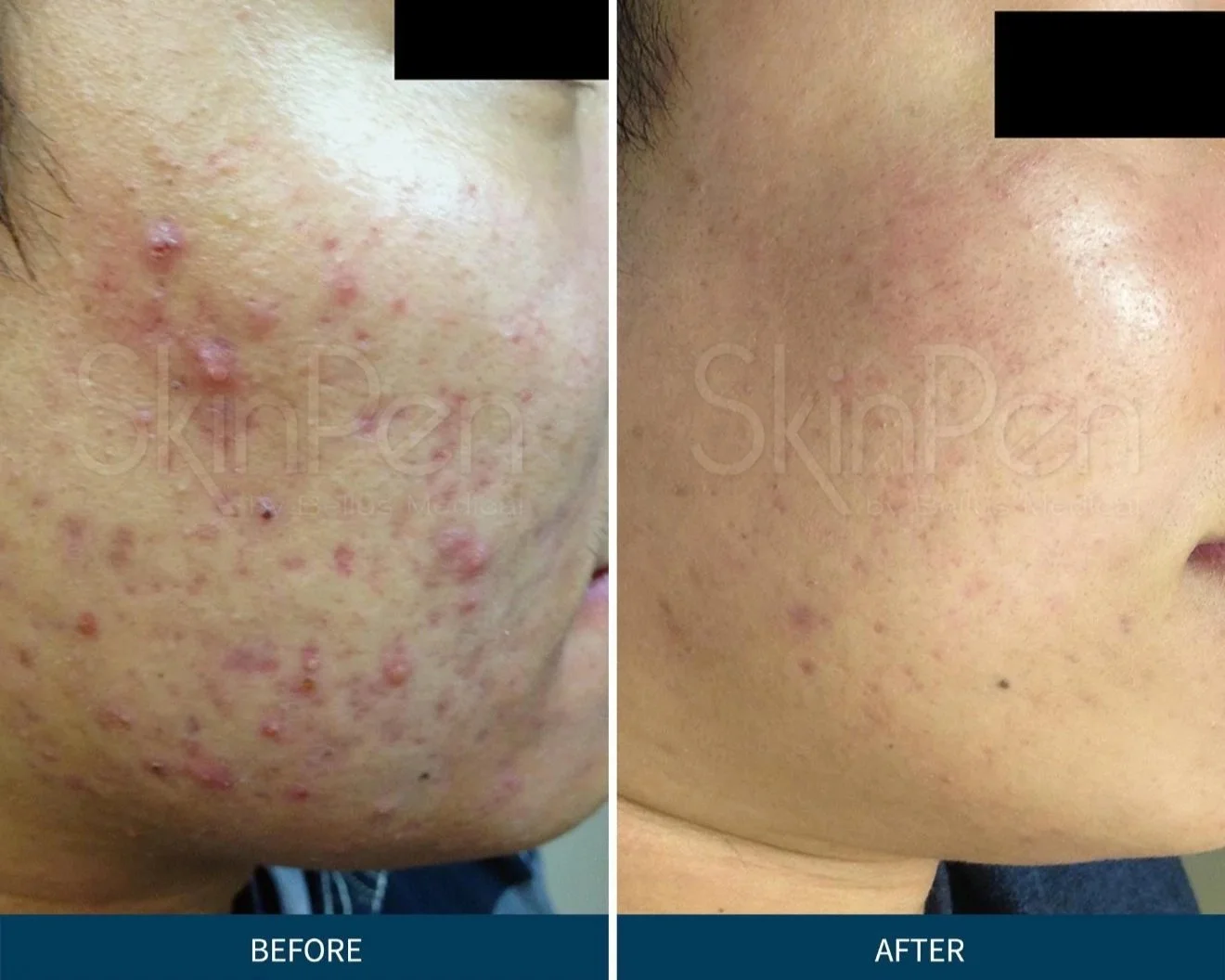 Side-by-side comparison of a man's lower face before and after laser skin treatment, showing improvement in skin texture and reduction of scars. 