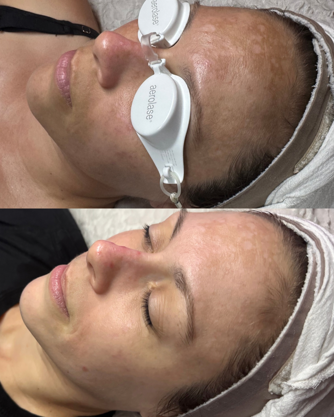 Side-by-side comparison of a woman's face showing sun damage and aging skin before and after skincare treatment.