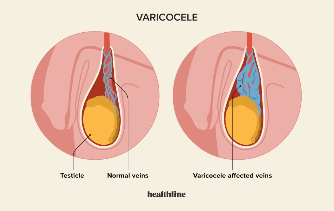 Male Infertility Part 1: Varicocele