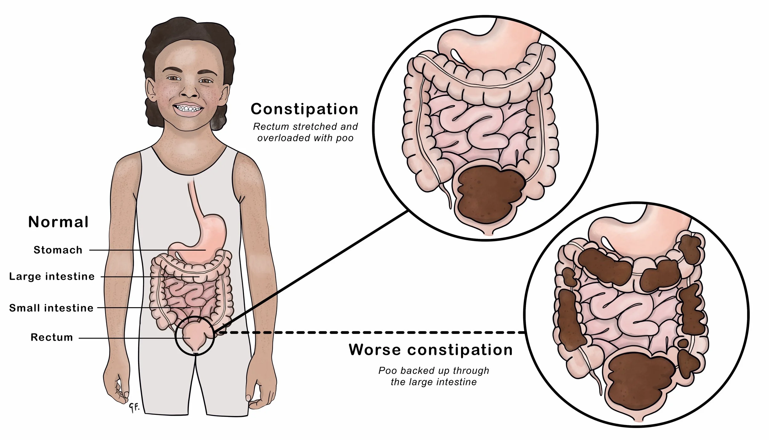 Constipation in Men, Why can't I poop?