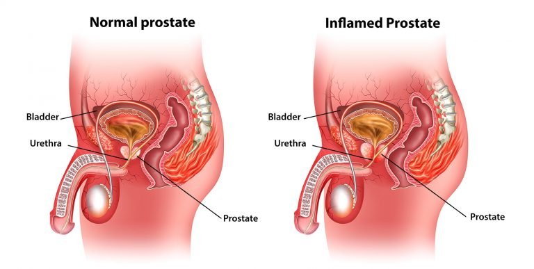 Understanding Prostatitis; Causes, Symptoms, and Treatment Beyond Antibiotics