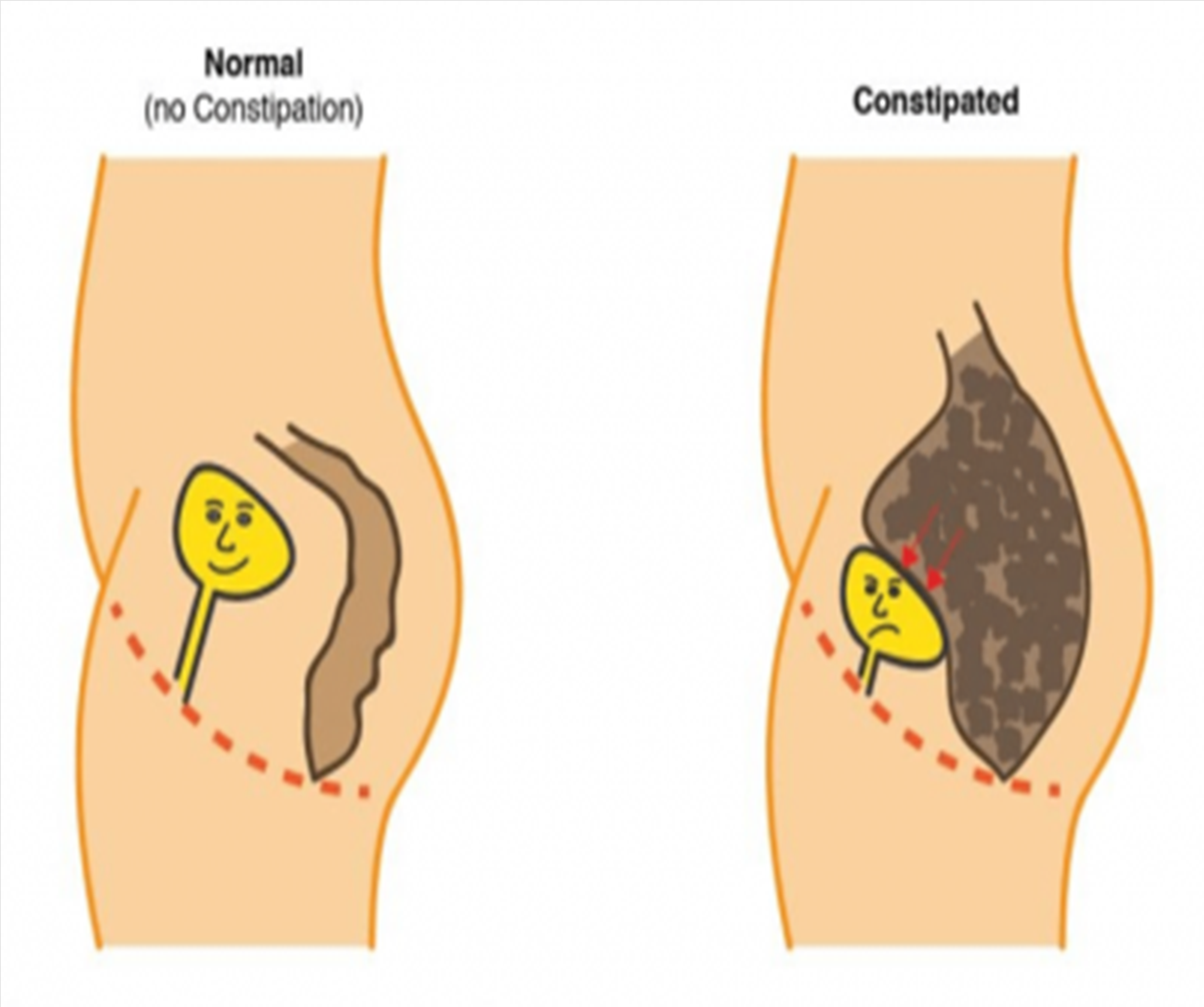 How Constipation Can Impact Pelvic Floor and Bladder Health