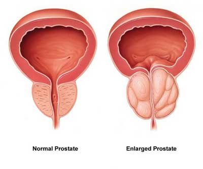 Understanding Benign Prostatic Hyperplasia (BPH) and Its Impact on Men