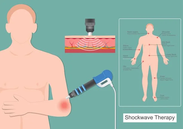 Shockwave Therapy (SWT) and Pelvic Floor Dysfunctions