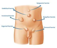 Testicular Pain after Inguinal Hernia Repairs