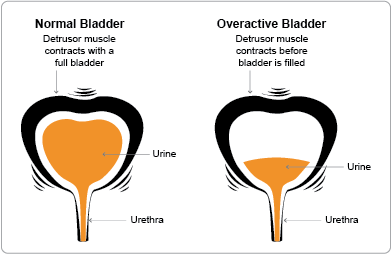 Urinary Urgency and Frequency