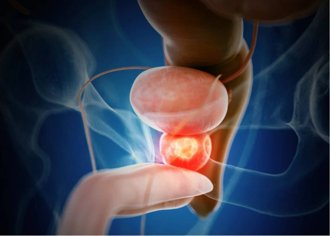 Stress Urinary Incontinence (SUI) in Men