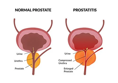 Prostatitis and Tight Pelvic Floor Muscles: A Comprehensive Guide