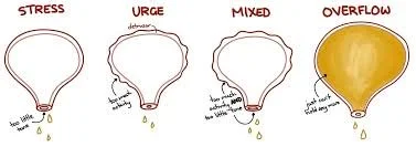 5 Types of Incontinence in the Male Pelvic Floor