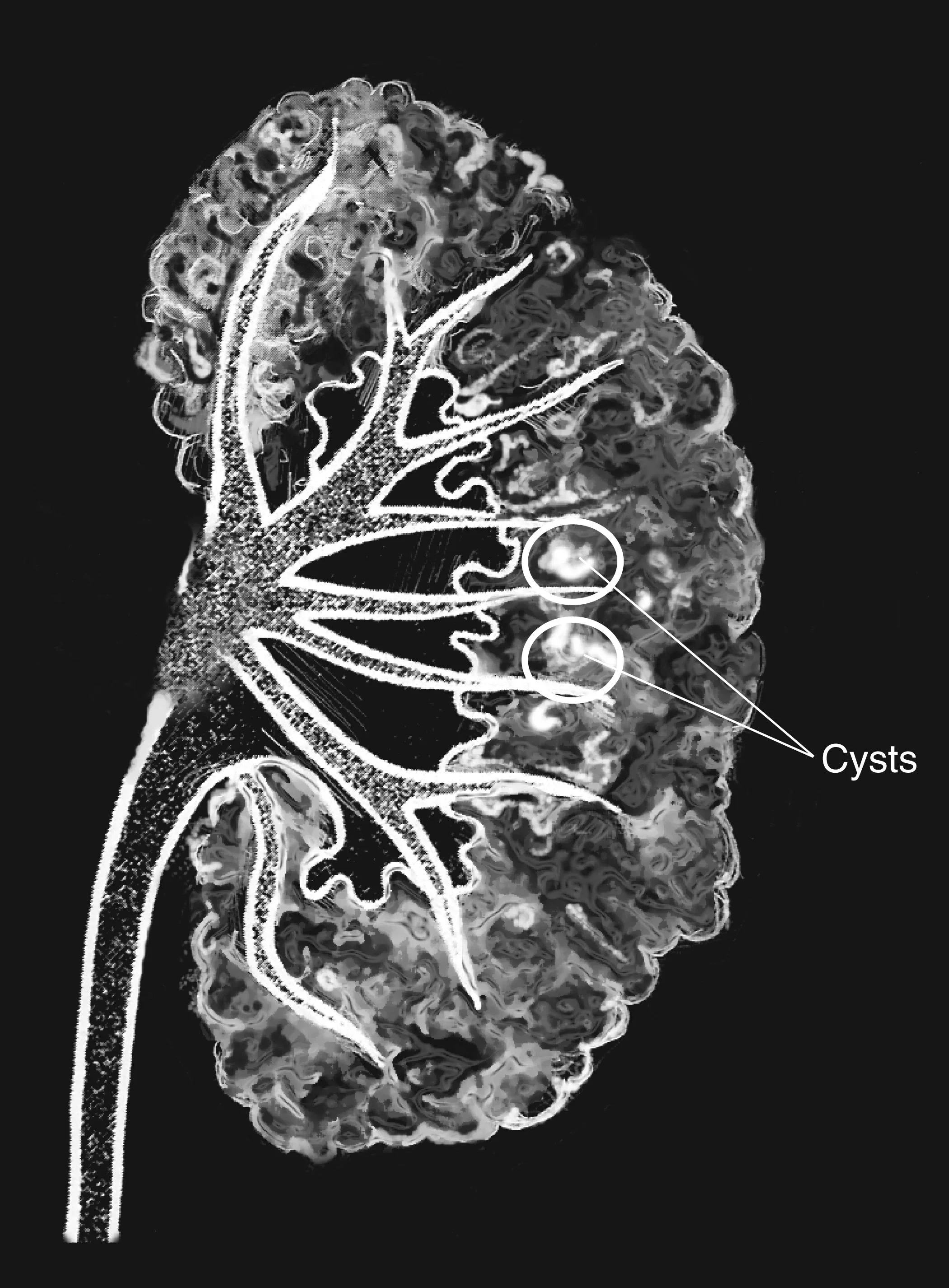 Sudden Burning or Painful Urination Can Be More Than a UTI: Medullary Sponge Kidney