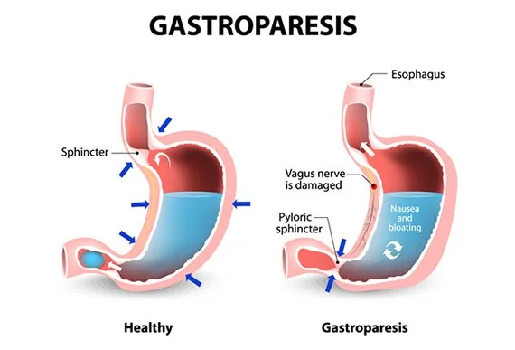 What is Gastroparesis and How Can A Pelvic Floor Physical Therapist Help Me?