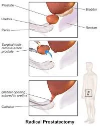 How Pelvic Floor Therapy Supports Recovery Before and After Prostatectomy