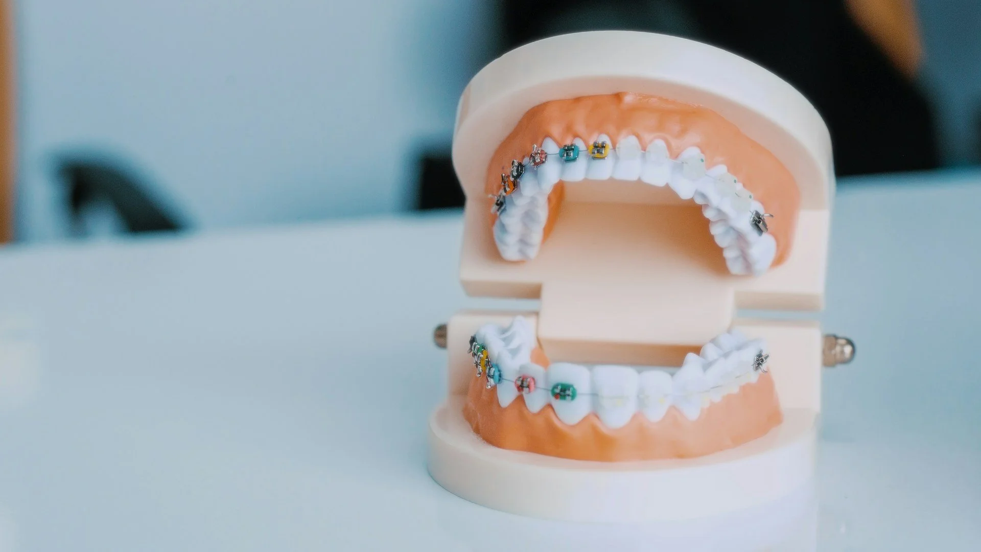Do Same-Day Crowns Look as Natural as Lab-Made Crowns?
