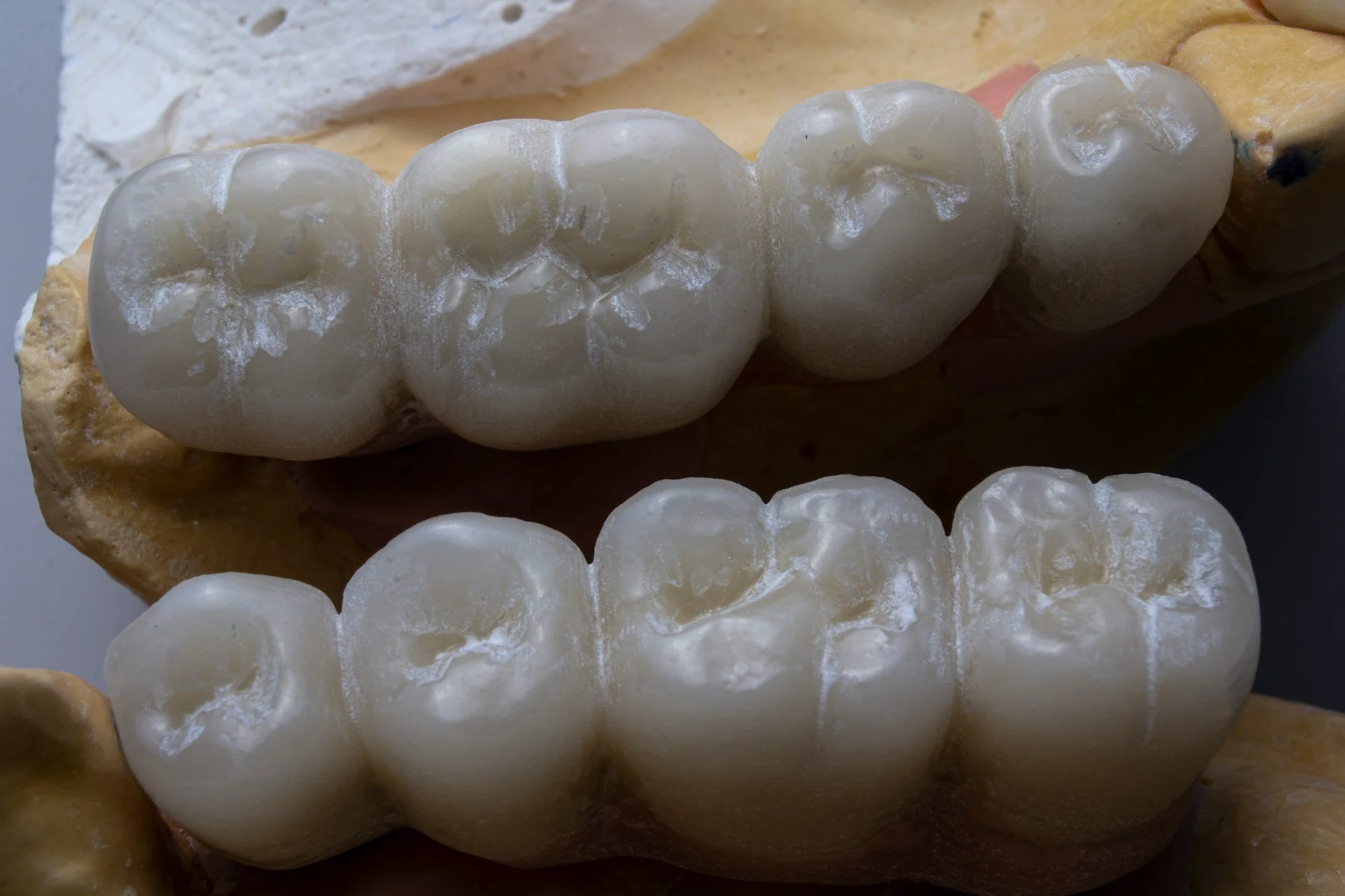 Comparing Materials: Porcelain vs Ceramic Crowns