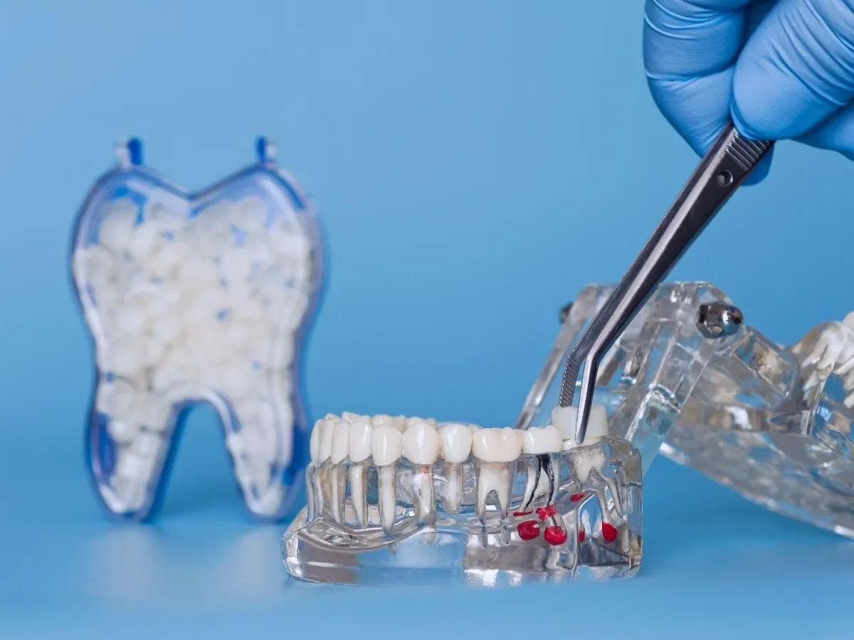 Cost of Same-Day Crowns in Langley: What Patients Should Know