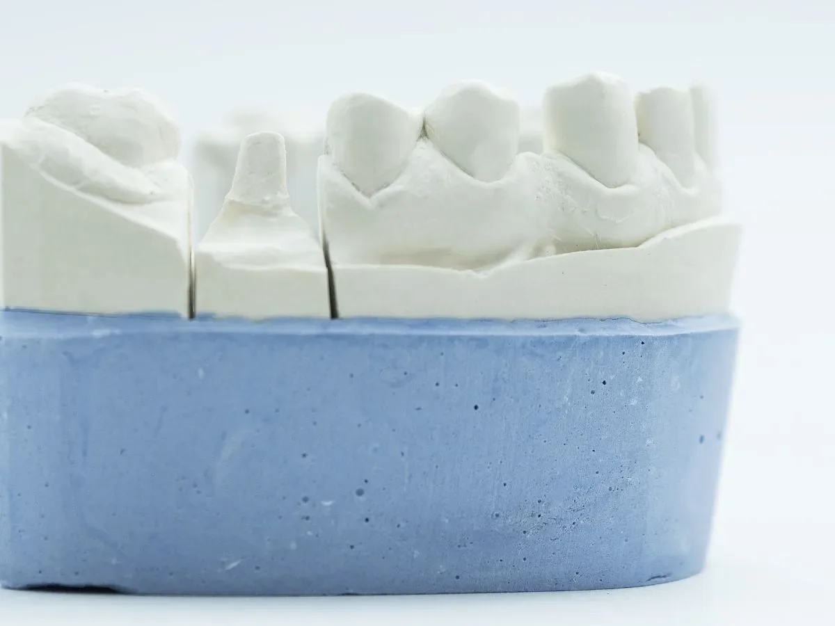 How to Care for Your Same-Day Crown After Treatment