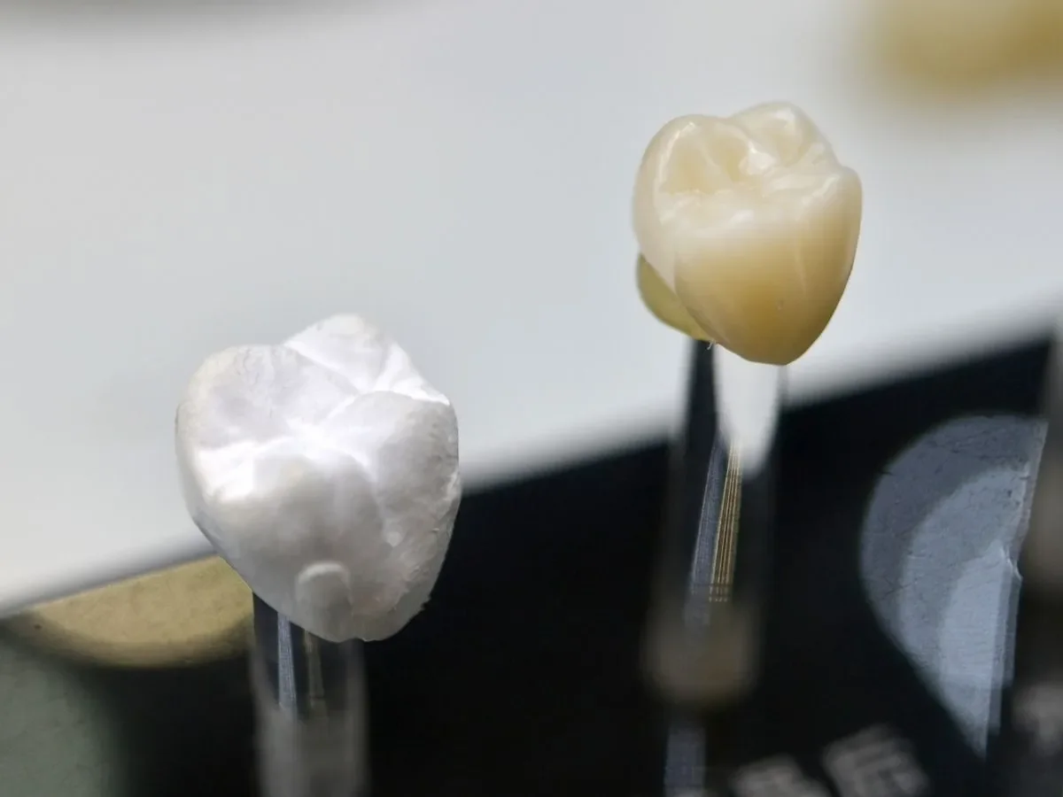 Do Same-Day Crowns Look as Natural as Lab-Made Crowns?